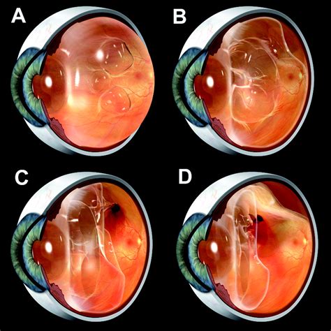Management Of Retinal Detachment A Guide For Non Ophthalmologists The Bmj