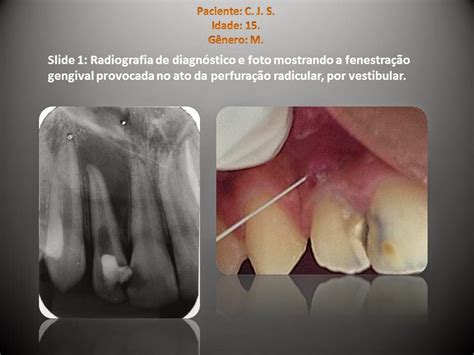 Endodontia Dr Henrique Braitt Retratamento endodôntico em dente que sofreu fenestração