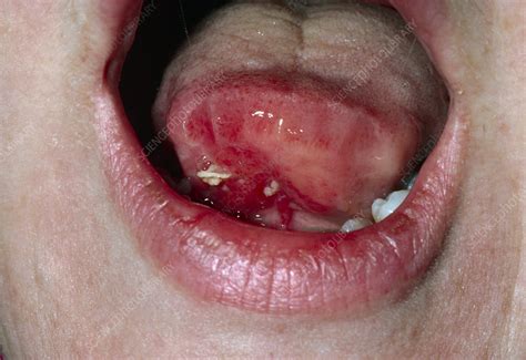 View Of Squamous Cell Carcinoma Of The Tongue Stock Image M1310191