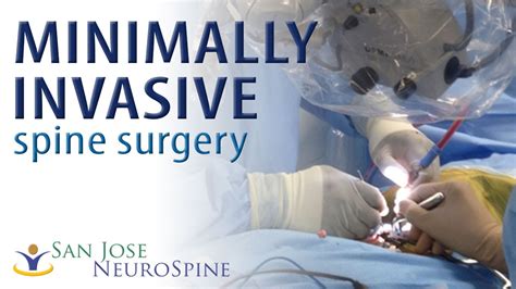 Minimally Invasive Spine Surgery Spine Center In San Jose Youtube