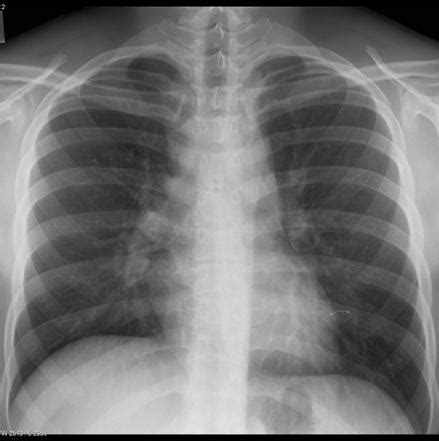 Hodgkin lymphoma | Image | Radiopaedia.org