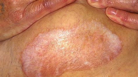 Lichen Sclerosus Treatment Causes And Symptoms