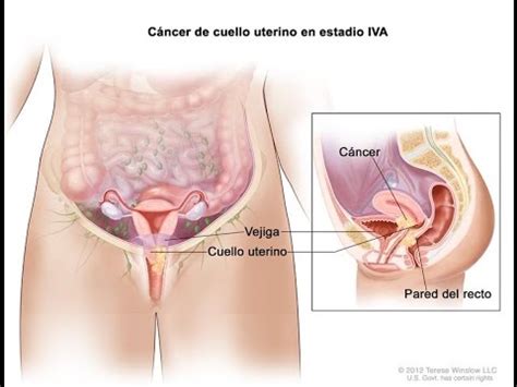 Dcis refers to abnormal cells that are confined to the milk ducts. CARCINOMA INTRACELULAR IN SITU - CANCER DE UTERO - YouTube
