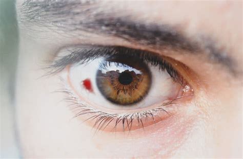 Subconjunctival Haemorrhage Blood Spot On The Eye All About Vision