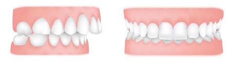What’s The Difference Between An Overbite And An Overjet Central Coast Orthodontics