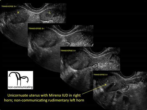 Congenital Uterine Anomalies A Resource Of Diagnostic Images Part 2