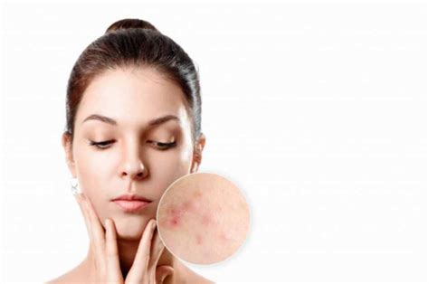 Skincare Untuk Fungal Acne Paling Efektif Doktersehat