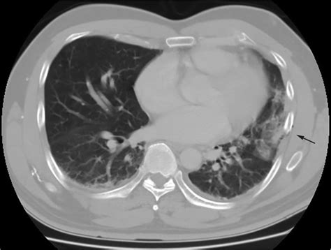 Computed Tomography Ct Scan Of The Chest Reveals Lung Atelectasis
