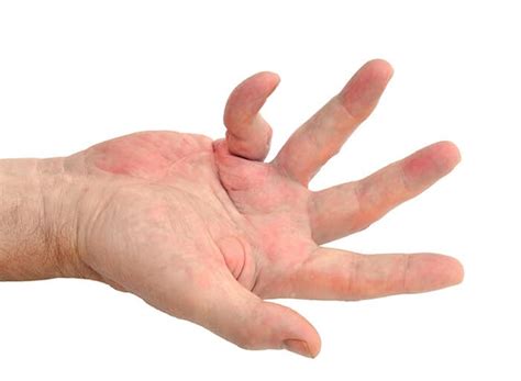 Dupuytrens Contracture Form Hand Wrist And Elbow Institute