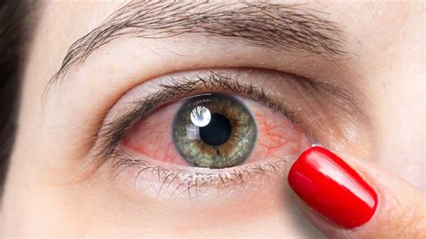 La Sindrome Dell Occhio Secco Quali Sono I Sintomi Come Si Cura