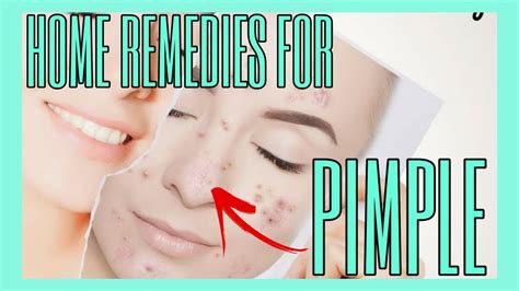 10 Home Remedies For Pimples Youtube