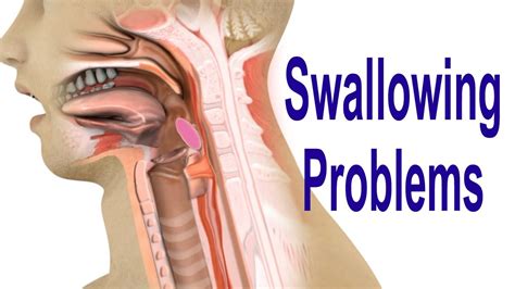 Swallowing Problems Or Dysphagia Top Possible Causes Including Cricopharyngeal Dysfunction