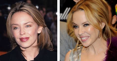 Kylie minogue plastic surgery before and after. Kylie Minogue's plastic surgery transformation over the ...