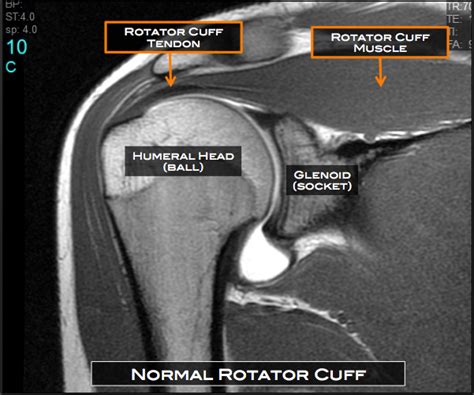 Shoulder Surgery Austin Tx Rotator Cuff Repair Cedar Park Round Rock