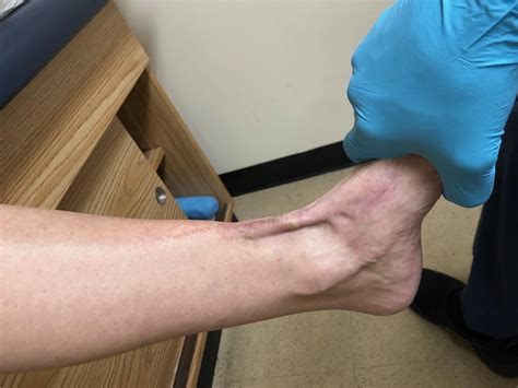 Chronic Tibialis Anterior Tendon Ruptures Considering A Key Surgical Option