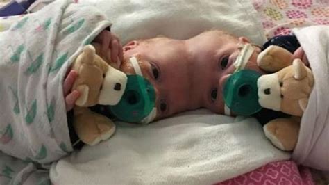 Conjoined Twin Girls From North Carolina Separated By Surgeons