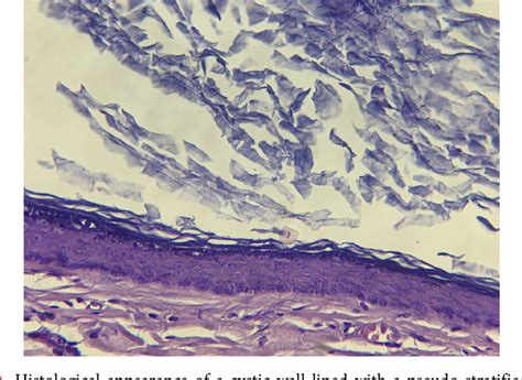 Figure 1 From Epidermal Inclusion Cyst A Rare Benign Breast Lesion