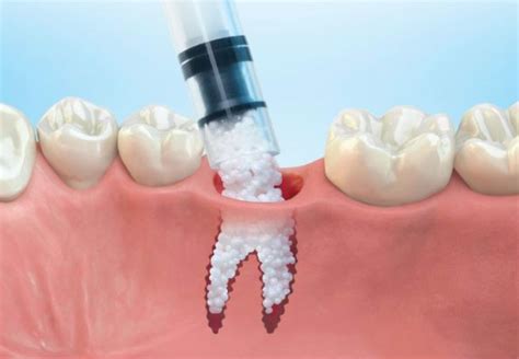 Bone Grafting For Dental Implants Periodontist In Birmingham Al