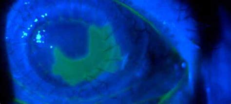 Úlcera de córnea causas sintomas olho tratamento cura