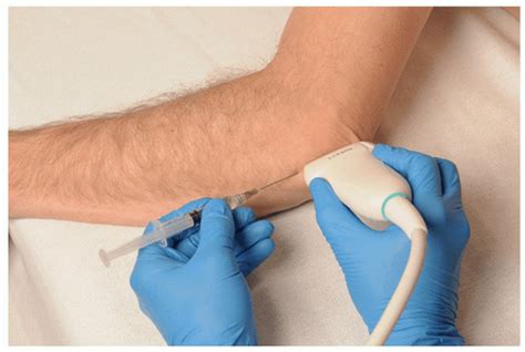 Ultrasound Guided Injection Technique For Cubital Tunnel Syndrome