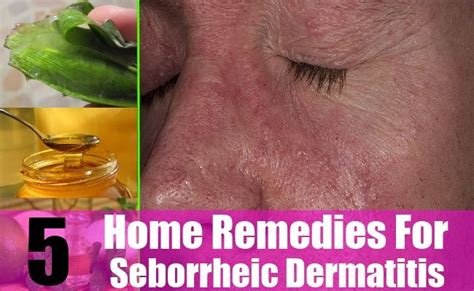 Seborrheic Dermatitis Eczema Behind Ears Javsystema