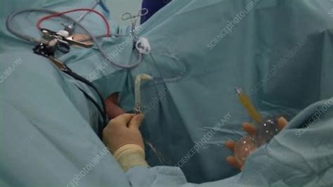 Bladder Evacuation During A Turp Biopsy Stock Video Clip K0038584 Science Photo Library