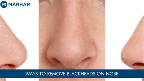 How To Get Rid Of Blackheads On Nose At Home Marham