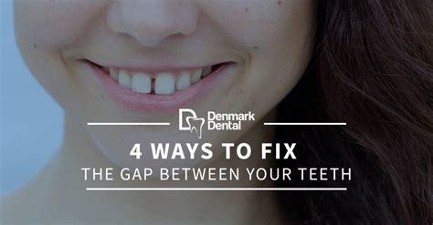 Have you ever felt the same because of the gap you have in your front teeth? Cosmetic Dentist Eagan: 4 Ways To Fix The Gap Between Your ...