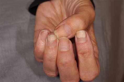 Does Lupus Affect Fingernails Tutor Suhu