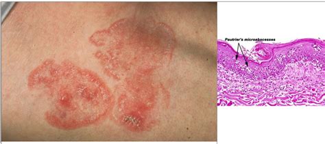 Mycosis Fungoides Pictures Stage