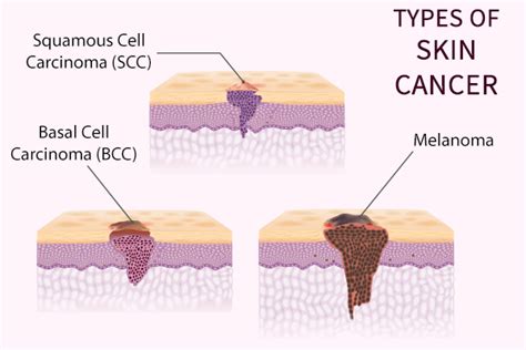 What Is Skin Cancer And How Fatal Is It Emedihealth