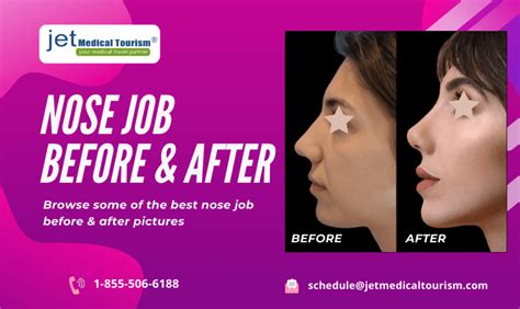 Nose Job Before And After Jet Medical Tourism® In Mexico