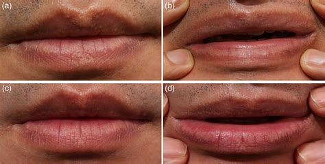 Sebaceous Glands Lips Pictures