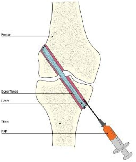 Prp Application Within The Grafted Tendons And Bone Tunnels Download
