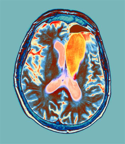 Brain Cancer Treatment Mri Scan Photograph By Du Cane Medical Imaging Ltd