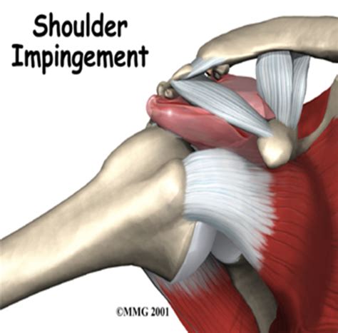 Diagram Of Shoulder Impingement Shoulder Impingementcausessymptoms