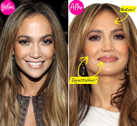 Jennifer Lopez Plastic Surgery Before And After Botox Injections