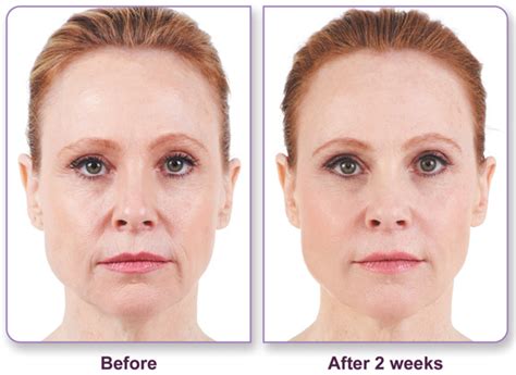 The Dos And Donts Of Fillers Charleston Facial Plastic Surgery