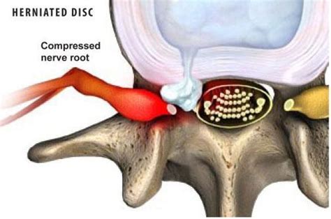 What Is A Herniated Disc Stephen P Courtney Md Orthopedic Spine Surgeon