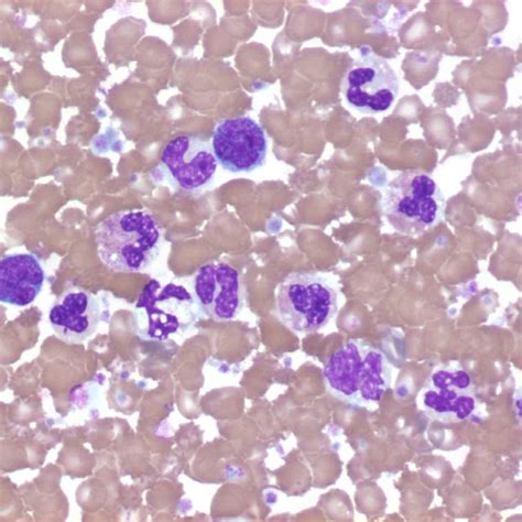 Peripheral Blood Smear Showed Marked Monocytosis And Dysplastic