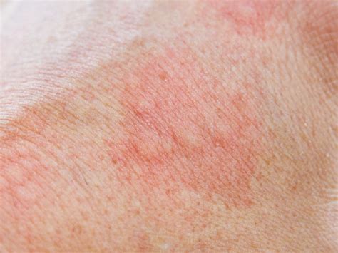 Skin Allergy Causes Symptoms And Home Remedies Styles At Life