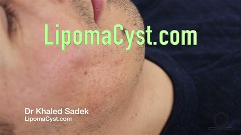 Face Cyst Removal Dr Khaled Sadek Youtube