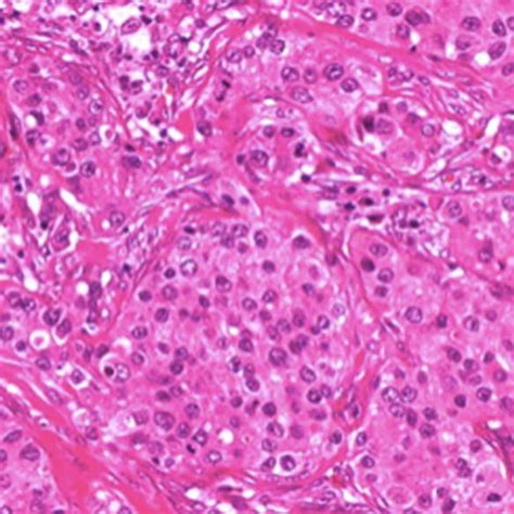 Acinic Cell Carcinoma Of The Parotid Gland Download Scientific Diagram