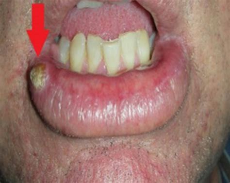 Health Tipswhite Spots On Lips Causes Pictures Lower