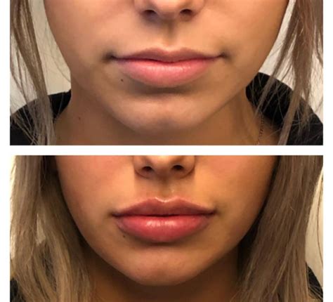 Benefits Of Lip Injections My Germanology
