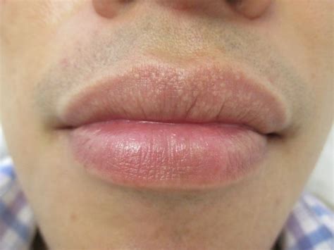 11 Tips To Prevent And Treat Fordyce Spots On Lips Fordyce Milia On