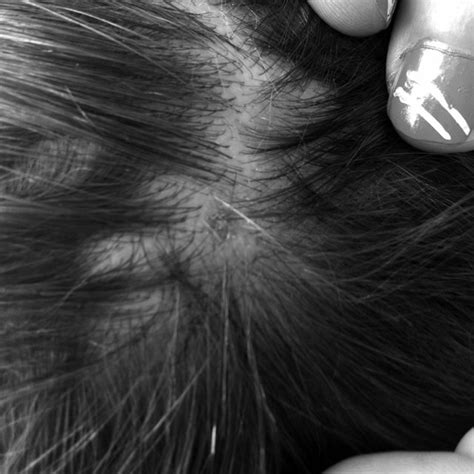 Figure Residual Alopecia 10 Weeks After Tick Bite In 13 Year Old Boy