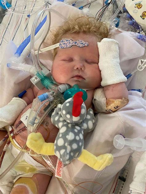 Baby Receives Worlds First Combined Heart And Thymus Transplant At Duke