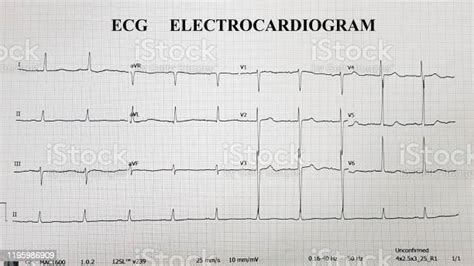 Electrocardiogram Show Normal Electrocardiography Ecg Used For