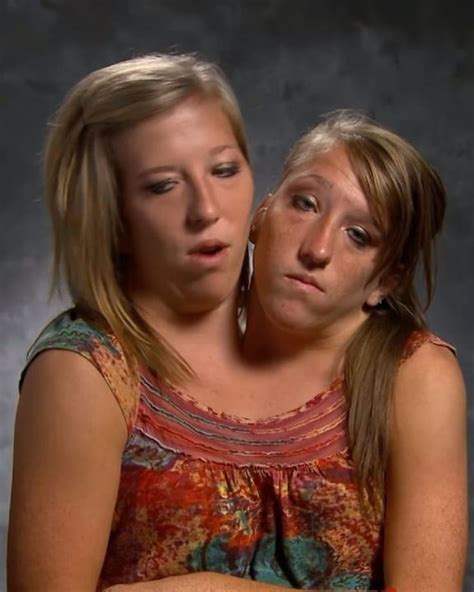 Brittany And Abby Hensel An Update On The Conjoined Twins